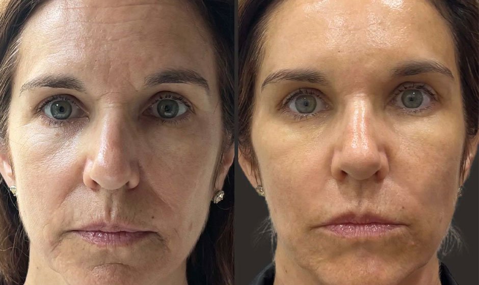 Restylane from Doctor Medica: Quality Fillers for Aesthetic Perfection